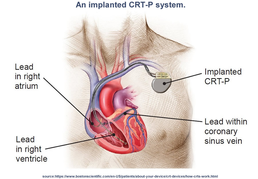 cardiac resynchronization therapy pacemaker (CRT-P